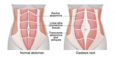 Diastasis Recti ( Abdominal Separation ) - PhysioCare