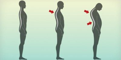 How Pilates Can Treat Thoracic Hyperkyphosis, also known as
